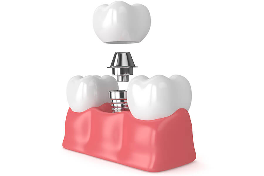 Implants Graphic Illustration